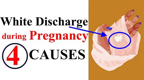 thick white discharge pregnancy test|early pregnancy discharge.